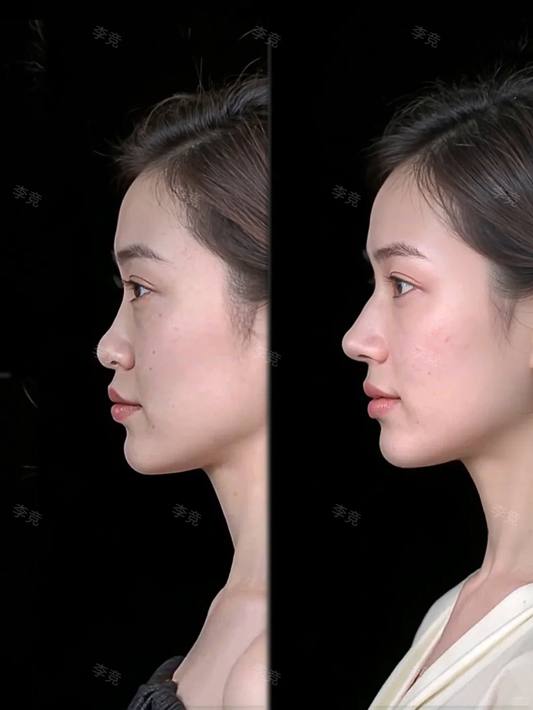 成都隆鼻|4mm抬高鼻背，微起伏精致骨感