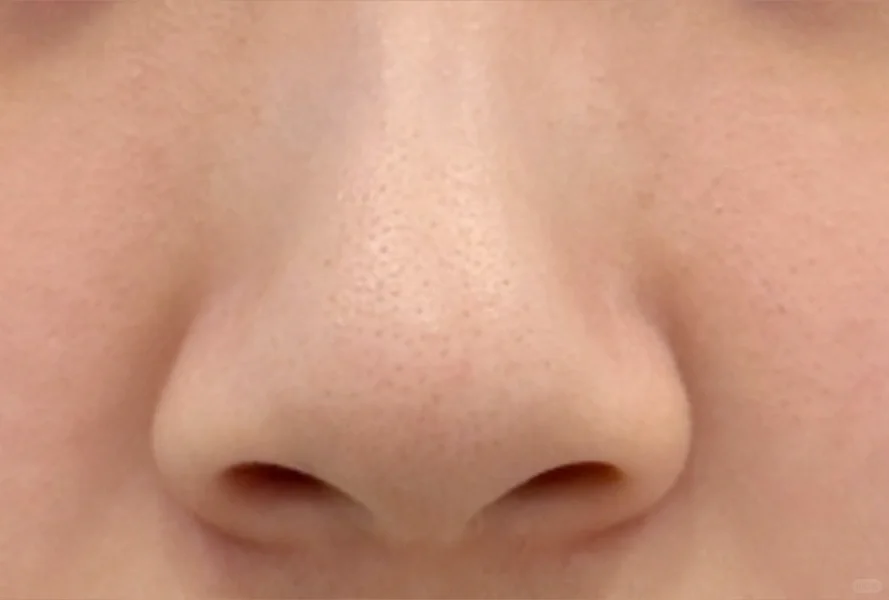 做了鼻翼鼻头缝合没放东西