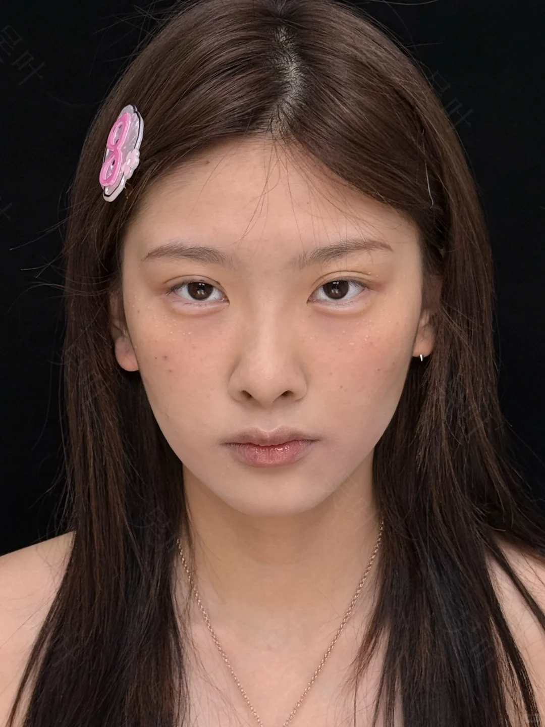 成都黑眼圈泪沟填充，live直出