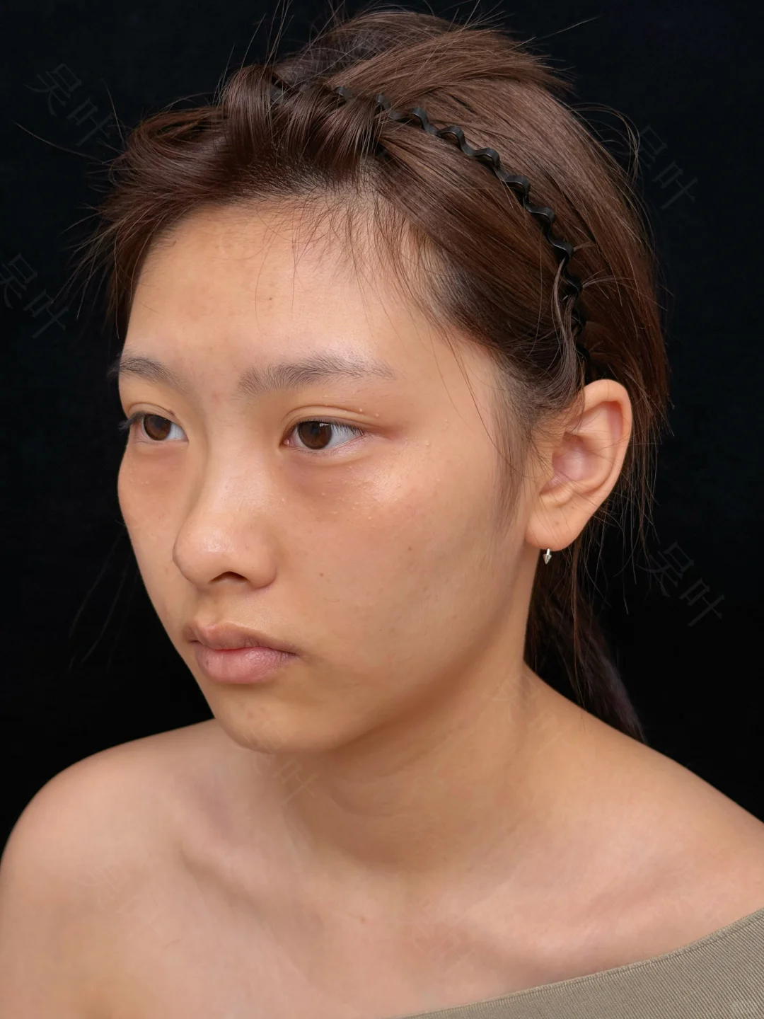 成都黑眼圈泪沟填充，live直出