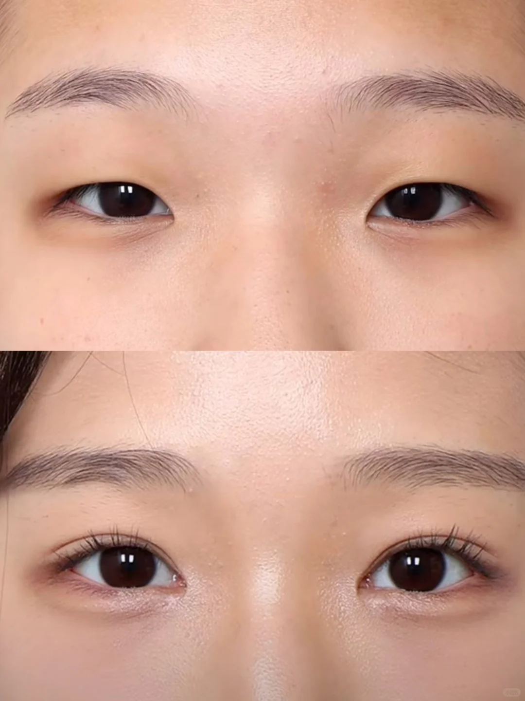 全切+开眼角-北京双眼皮展示