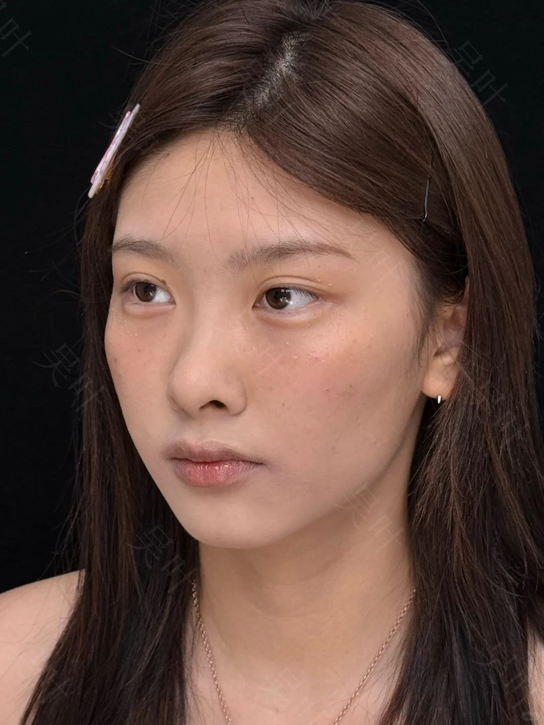 成都黑眼圈泪沟填充，live直出