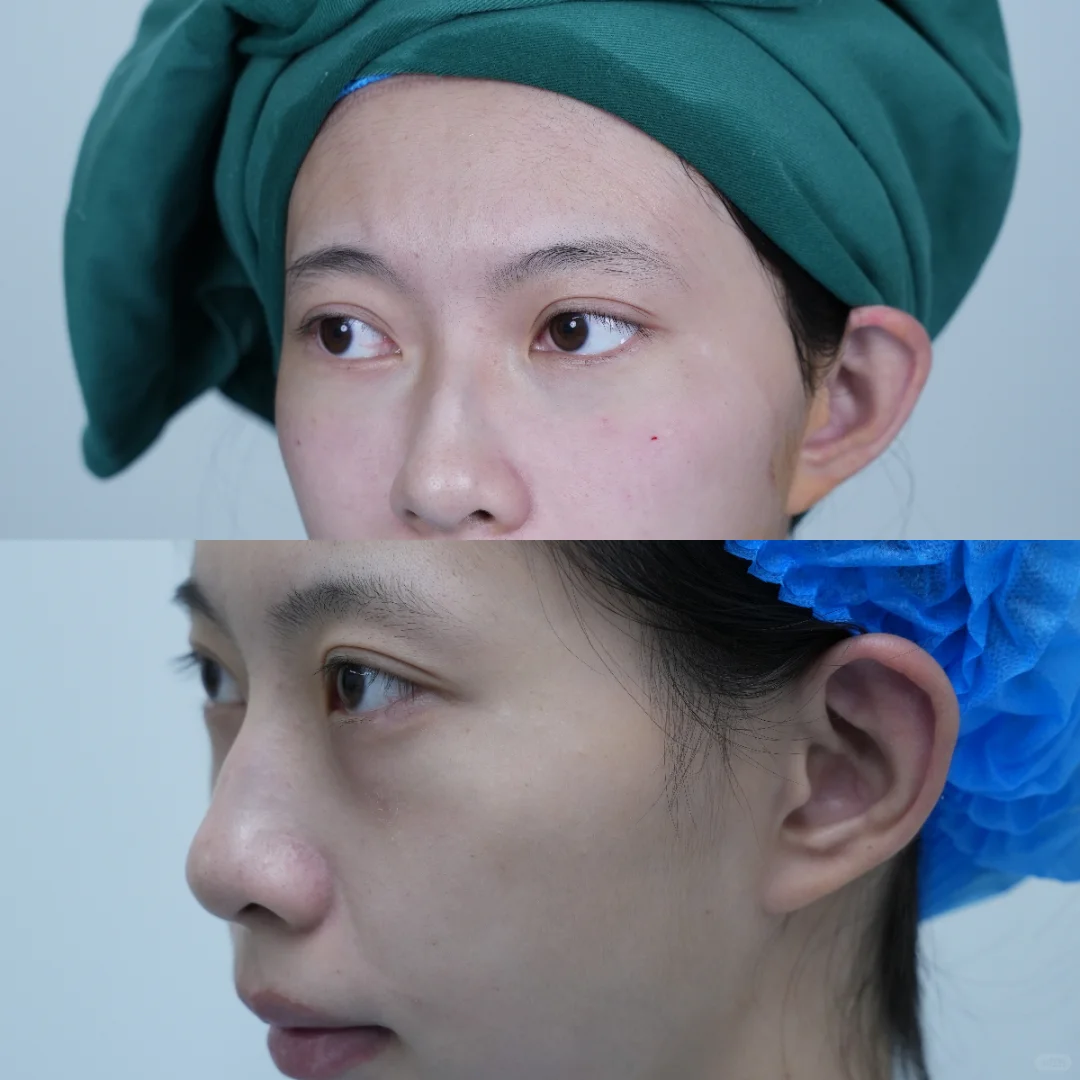 嘎完眼袋后就像变了一个人