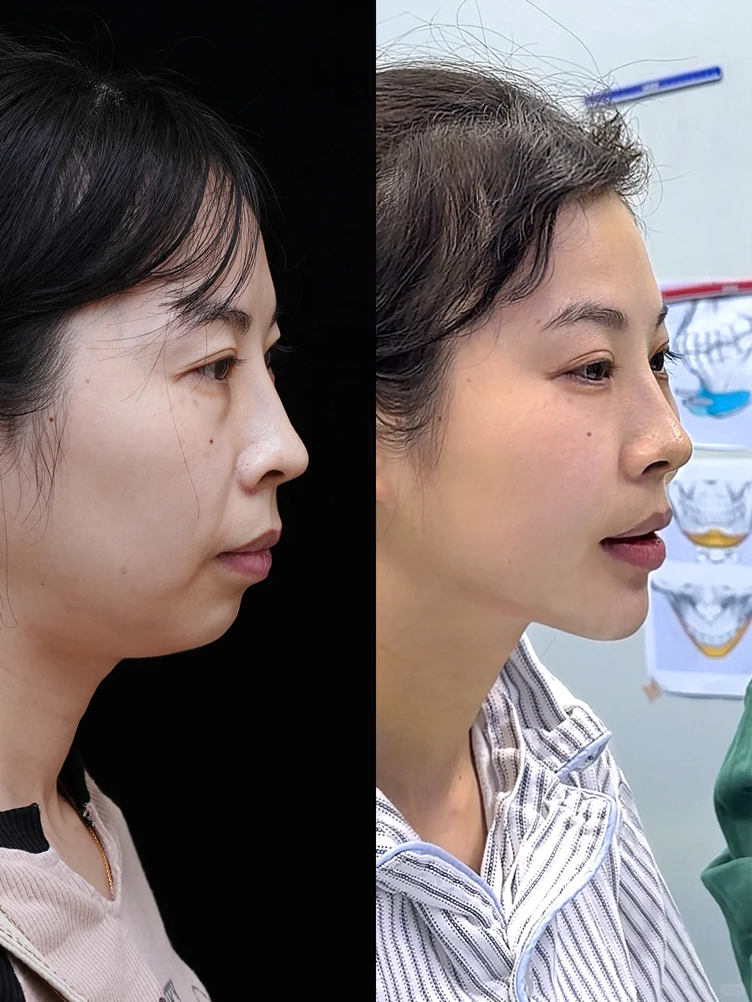 真的真的真的只是做了个下巴！