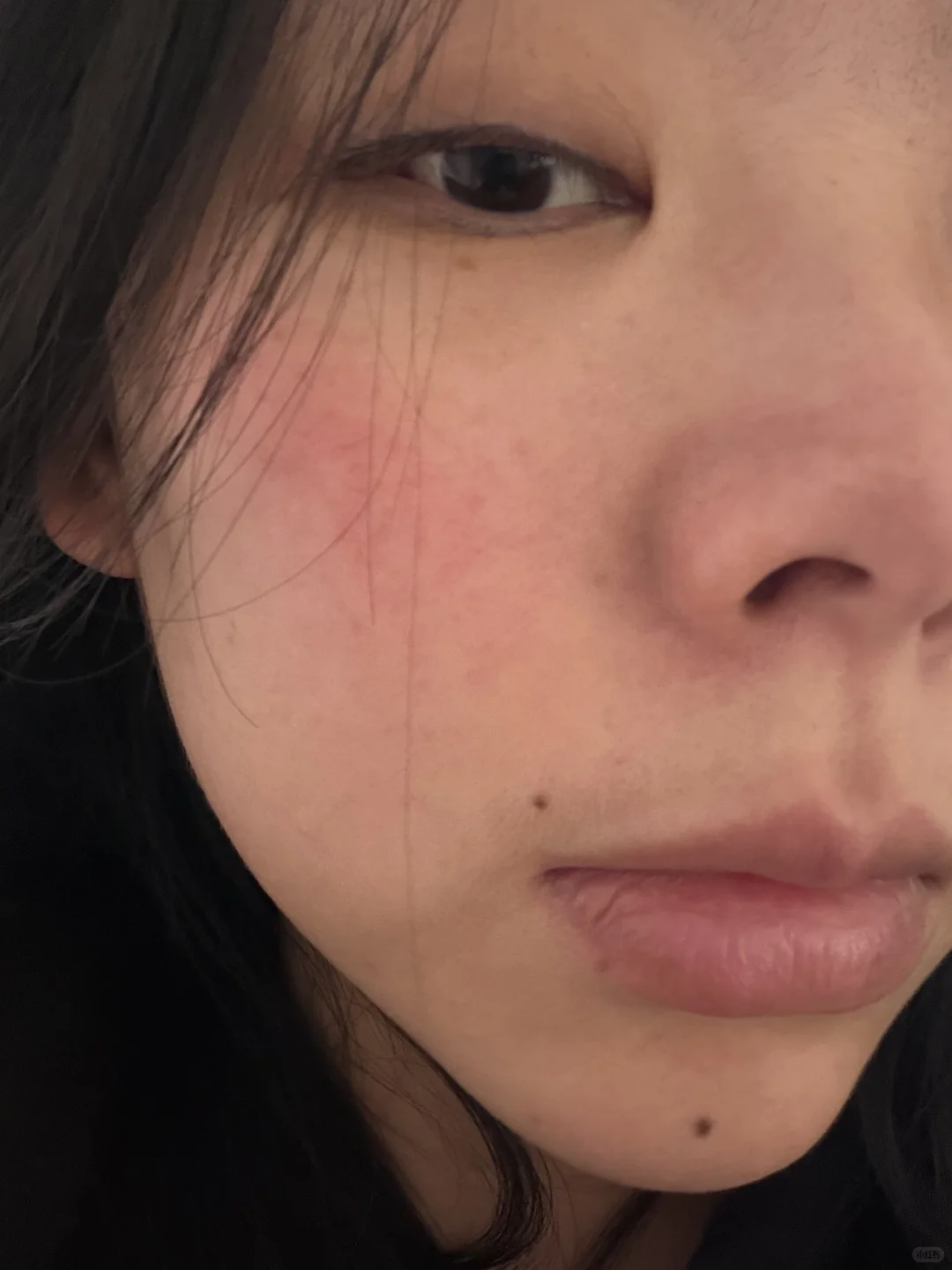 做完燃料第二天右边脸微微肿了