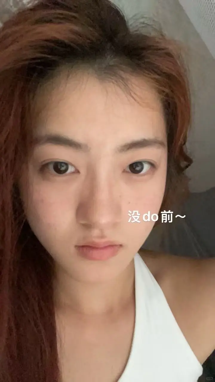 广州鼻子｜3个月现状