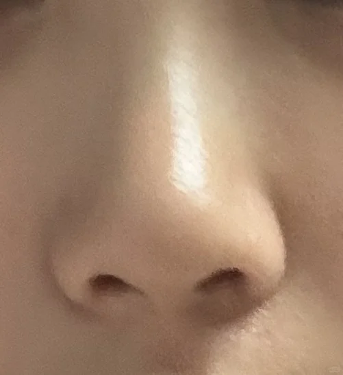 做了鼻翼鼻头缝合没放东西