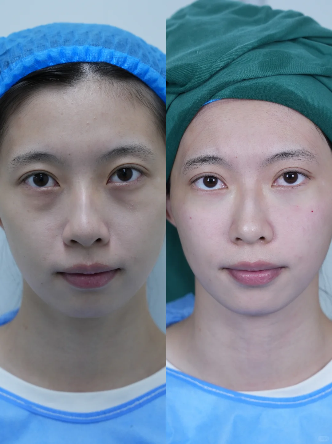 嘎完眼袋后就像变了一个人