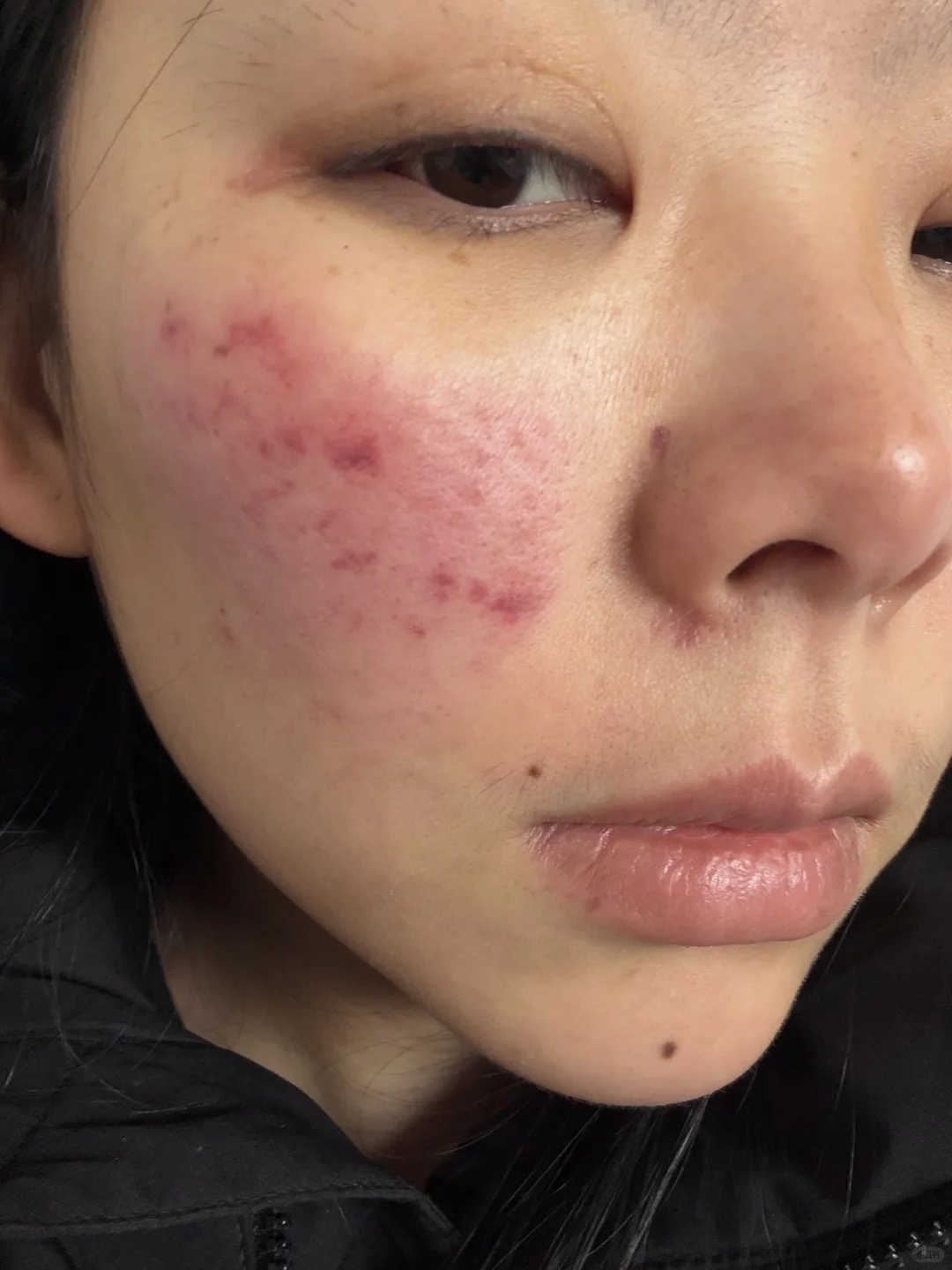 做完燃料第二天右边脸微微肿了