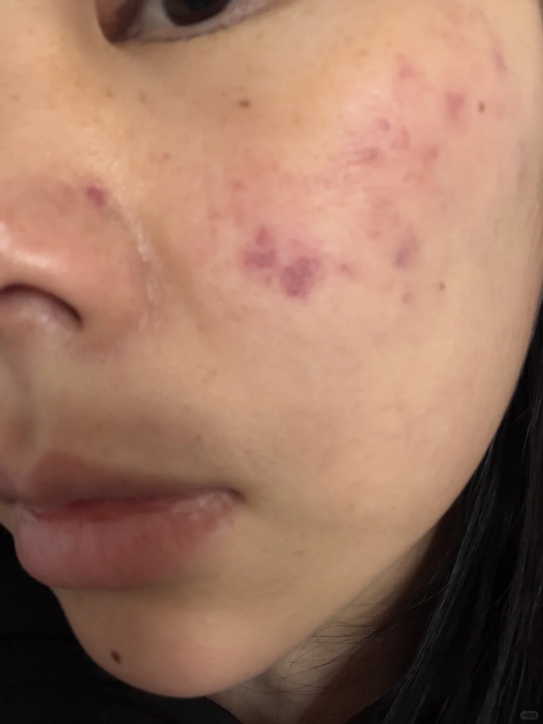 做完燃料第二天右边脸微微肿了