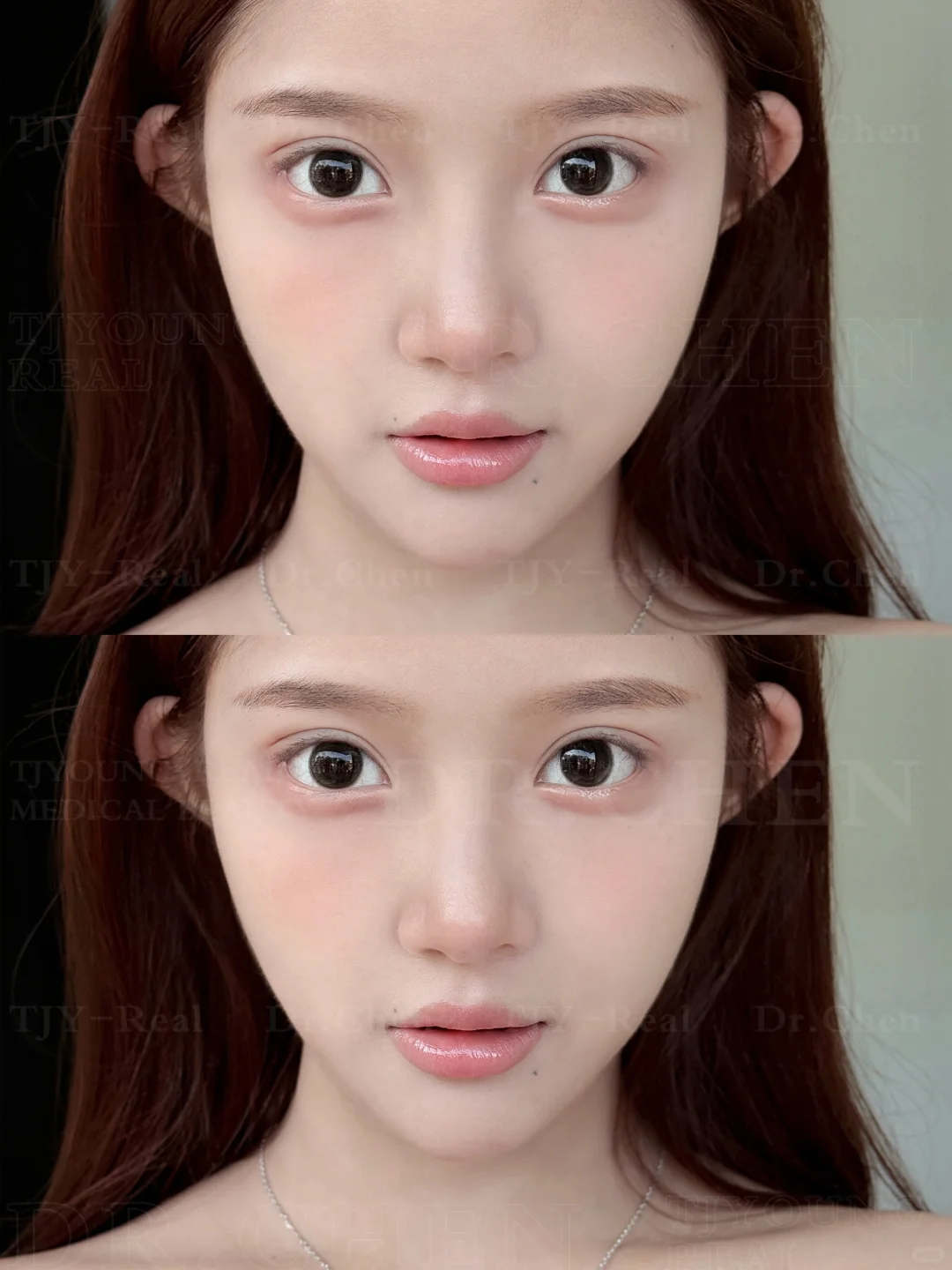 漫画款双眼皮｜7.8mm素颜也美❕