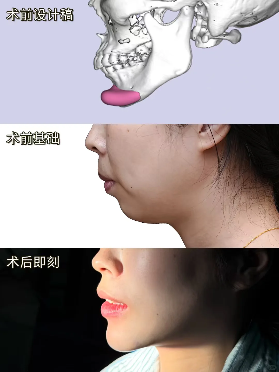 真的真的真的只是做了个下巴！