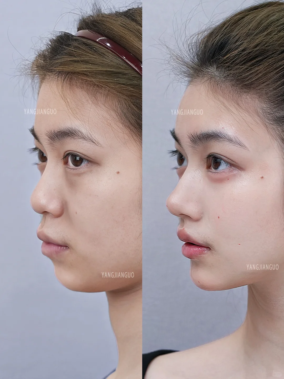 2支濡白鼻+鼻基底+下巴，微调完像换了一张脸