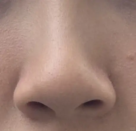 做了鼻翼鼻头缝合没放东西
