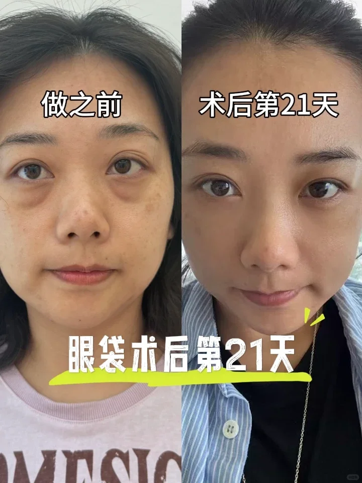 普通人噶眼袋第21天，太值了！
