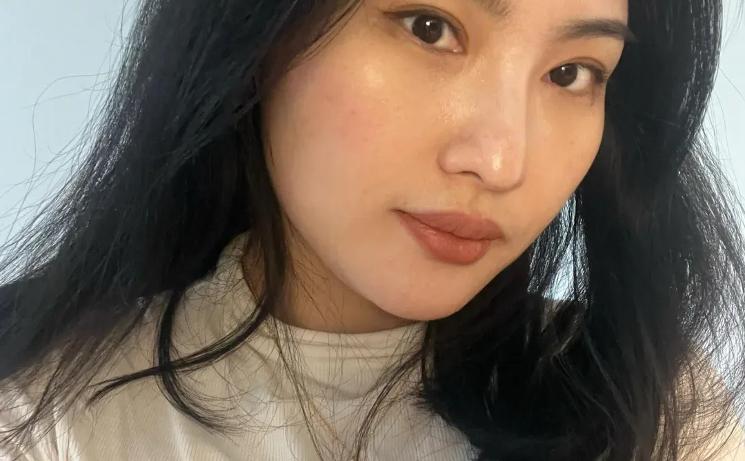 皮贴骨，内窥镜小切口筋膜提升1个月