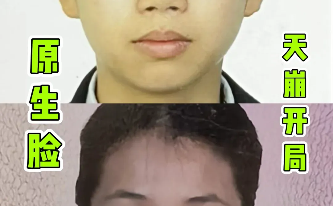 鼻子3次变化过程自卑只要70万就能消失