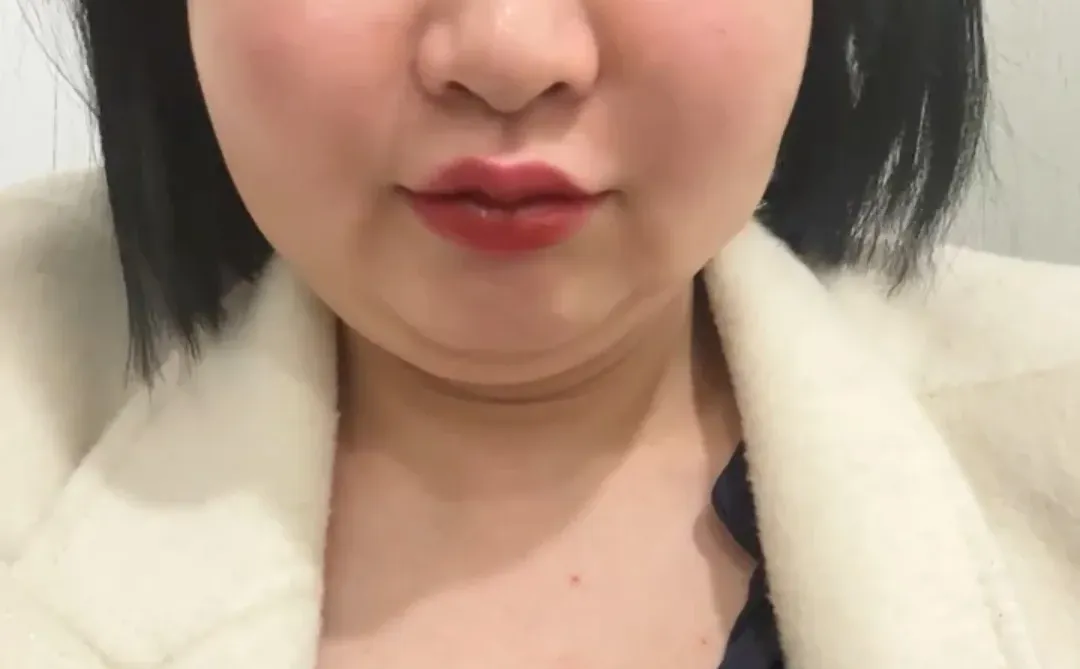 20支ZS填充物毁了我的脸