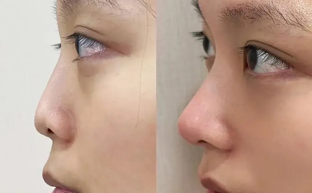 下巴后缩➕鼻子，3支就够了