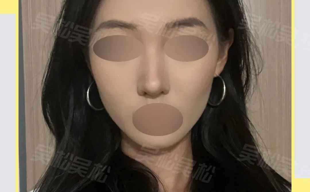 do鼻调整：塌鼻爆改自然精致鼻！