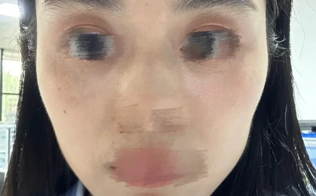 肉毒素一年6个月了，千万不要去打，不要打！！！