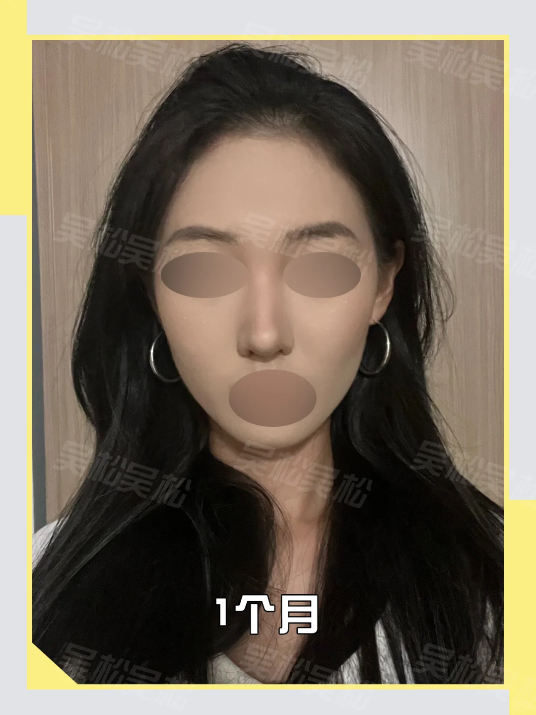 do鼻调整：塌鼻爆改自然精致鼻！