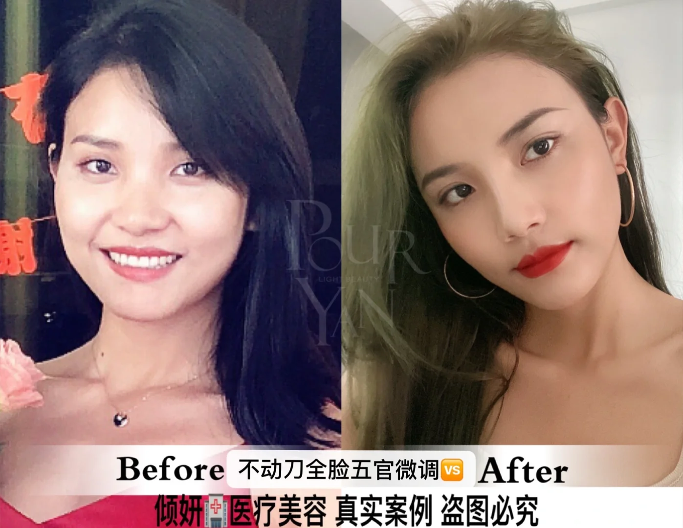 全脸都do了‼️但❓告诉我真的变好看了吗⁉️