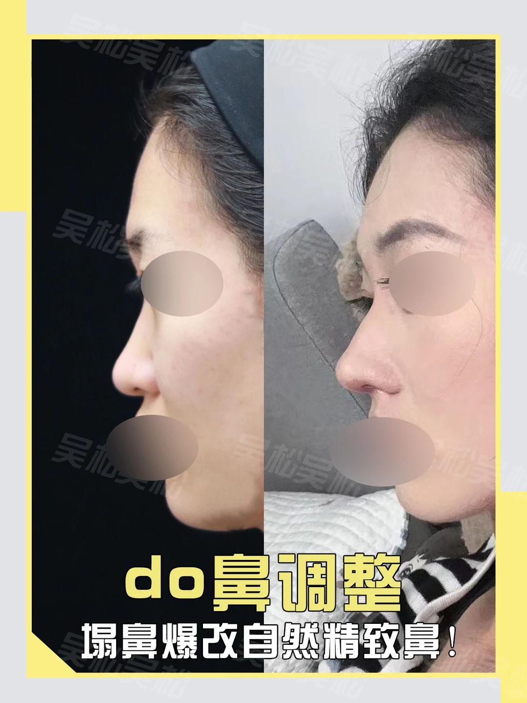 do鼻调整：塌鼻爆改自然精致鼻！