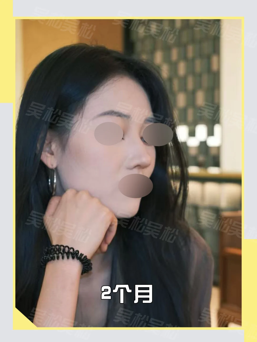 do鼻调整：塌鼻爆改自然精致鼻！