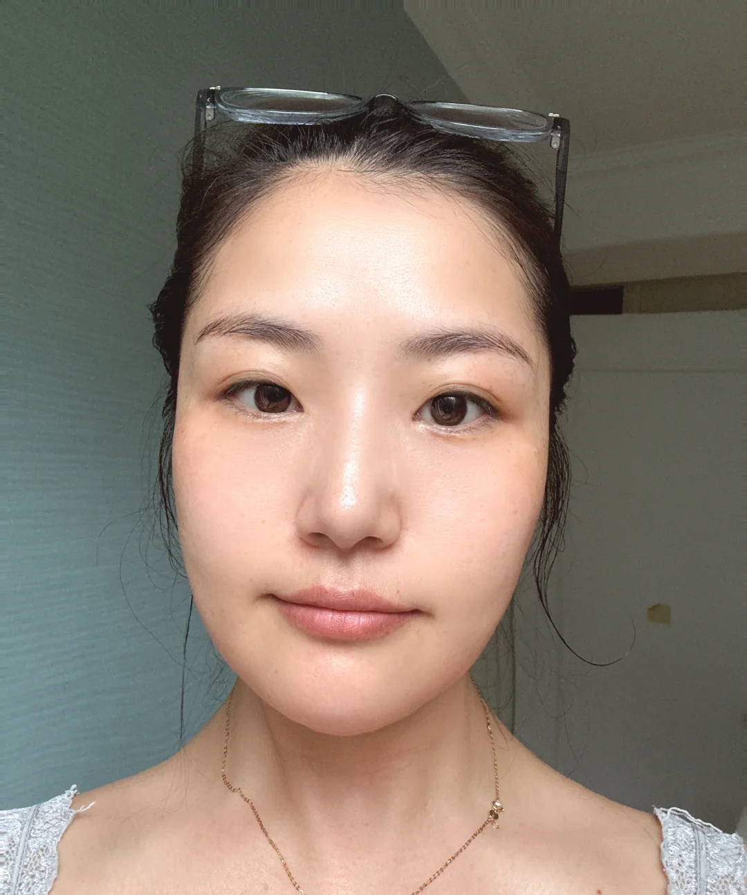 西安35＋职场宝妈首次注射太阳穴恢复情况