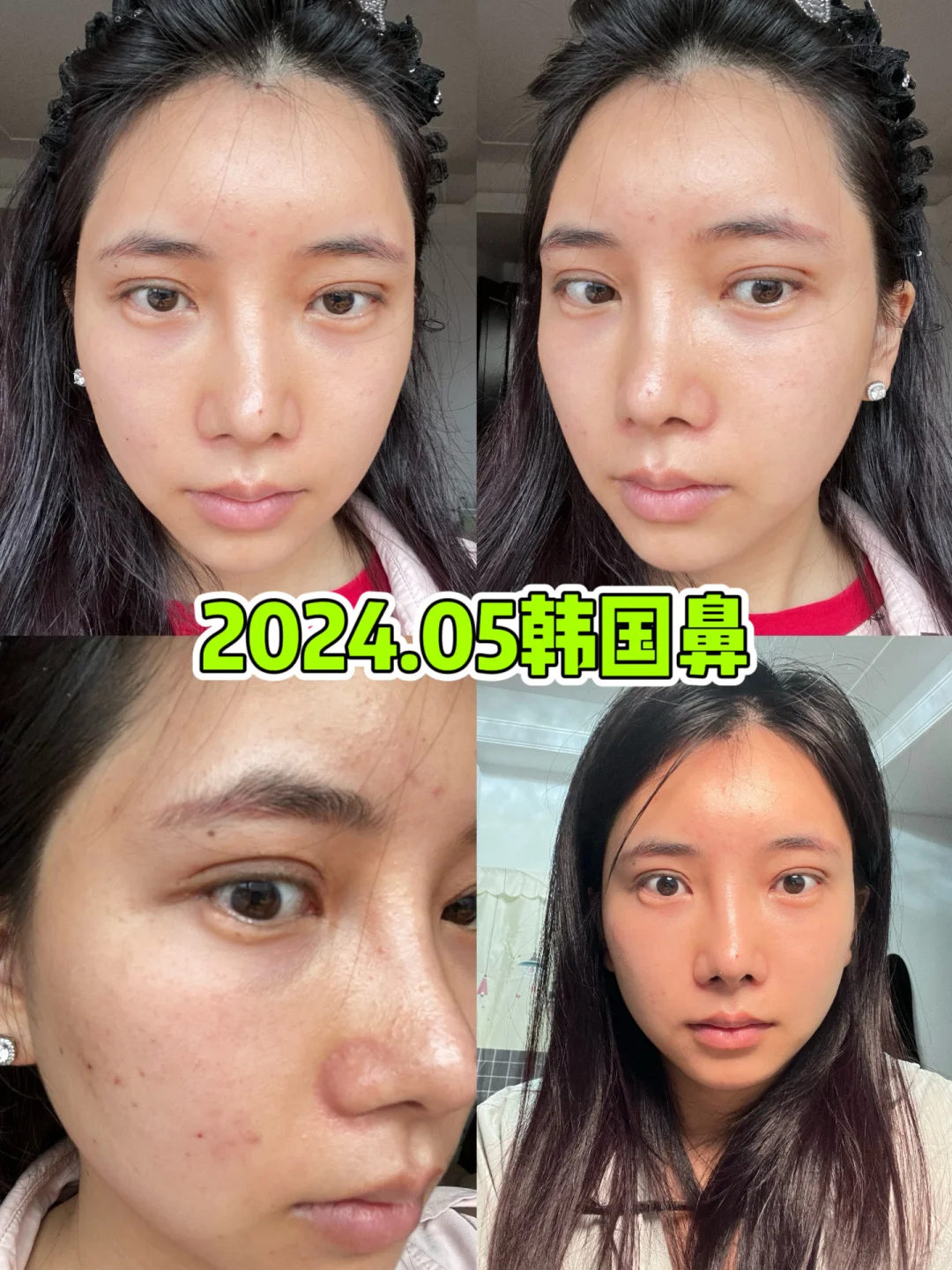 鼻子3次变化过程自卑只要70万就能消失