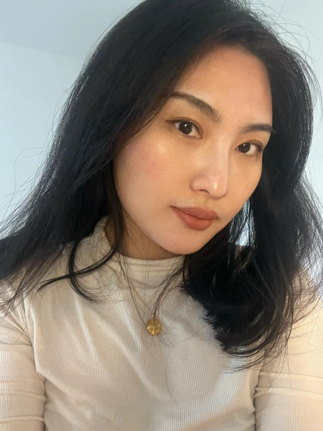 皮贴骨，内窥镜小切口筋膜提升1个月