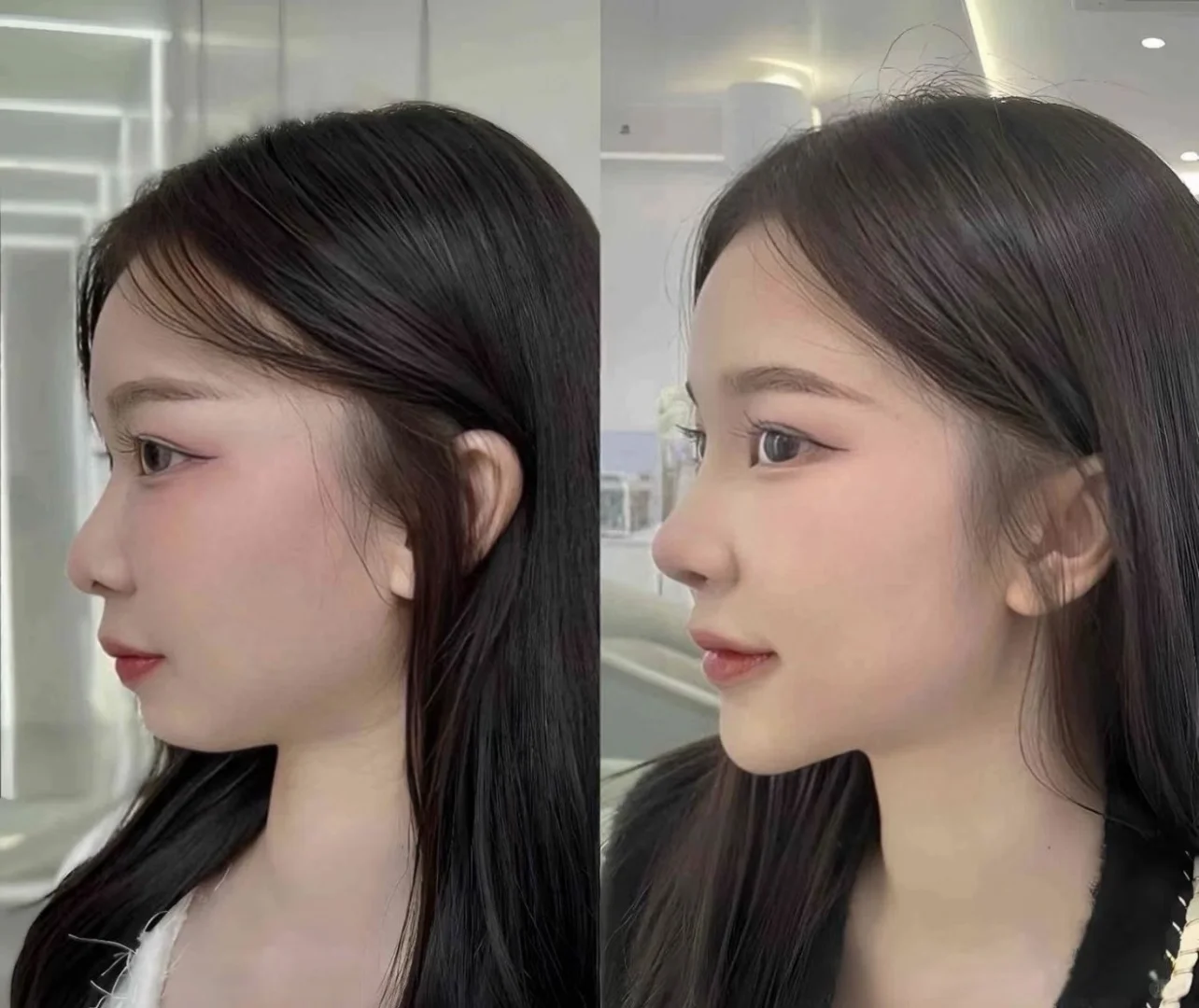 挣点钱全花脸上来啦🥹🥹🥹不过变美就是值得