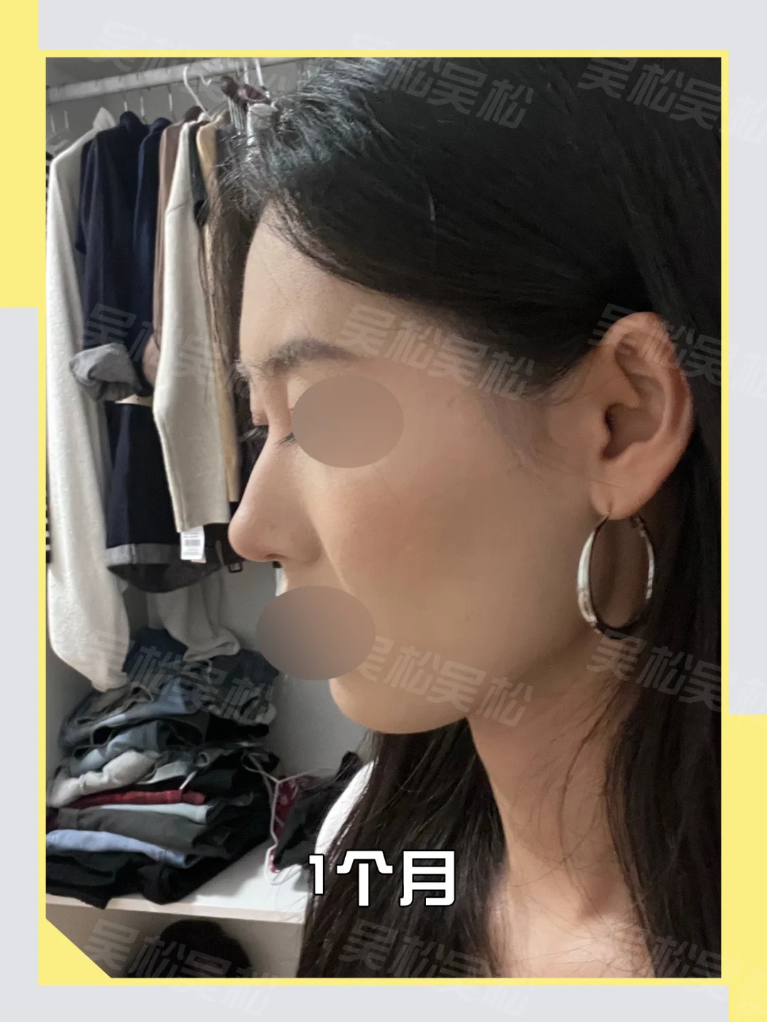 do鼻调整：塌鼻爆改自然精致鼻！