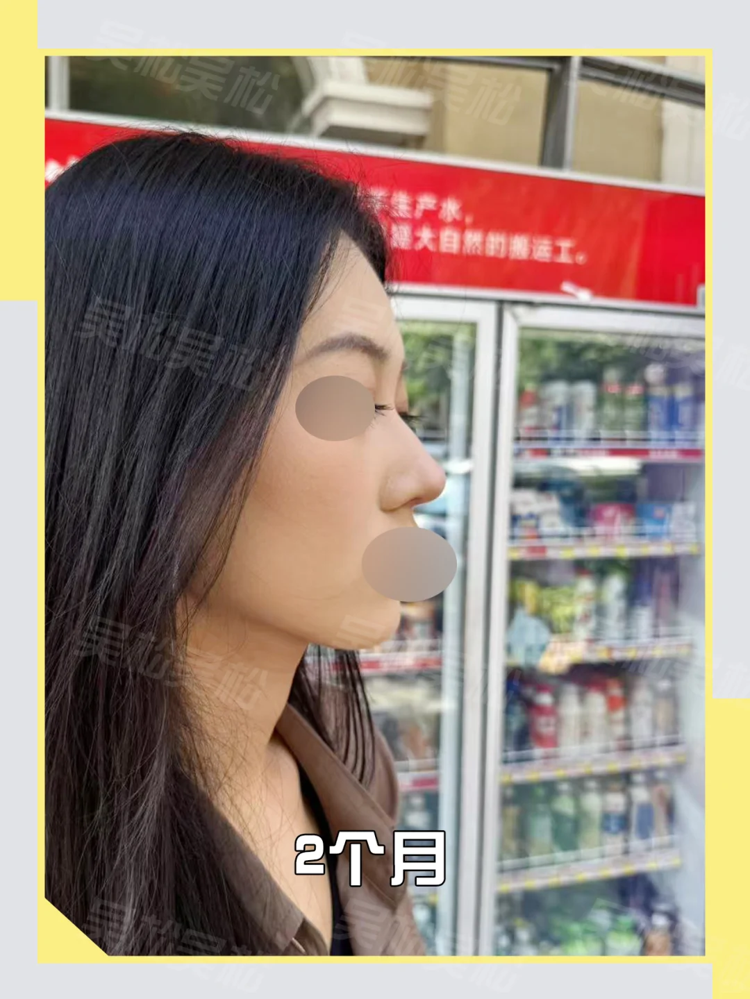 do鼻调整：塌鼻爆改自然精致鼻！