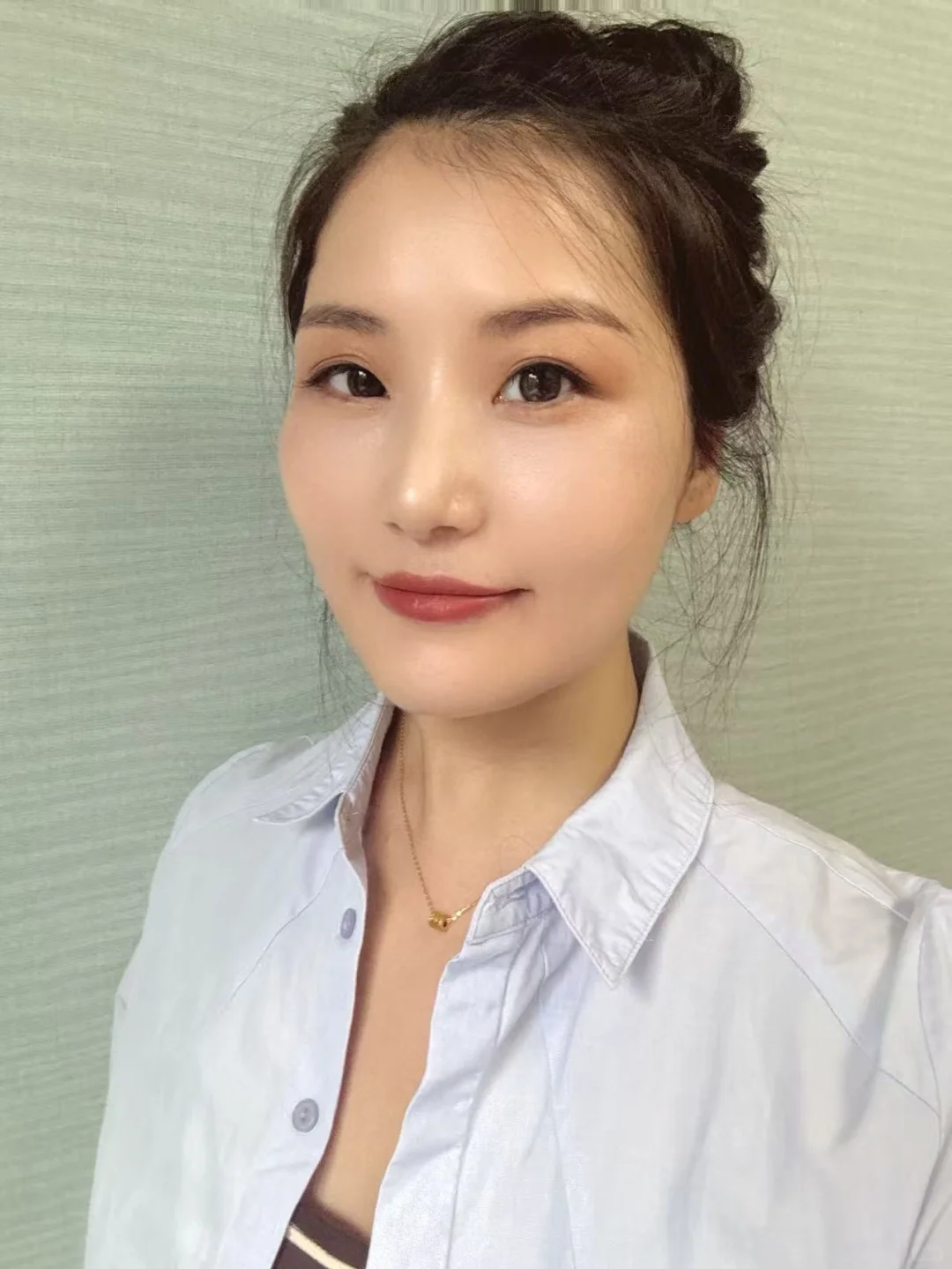 西安35＋职场宝妈首次注射太阳穴恢复情况