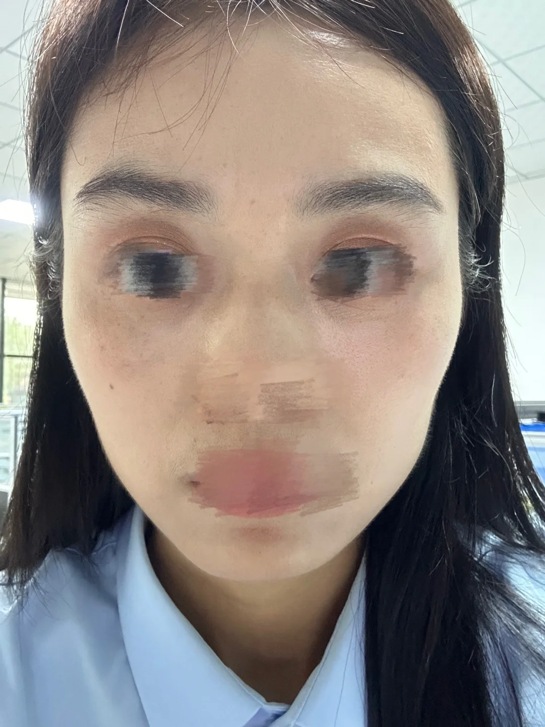 肉毒素一年6个月了，千万不要去打，不要打！！！