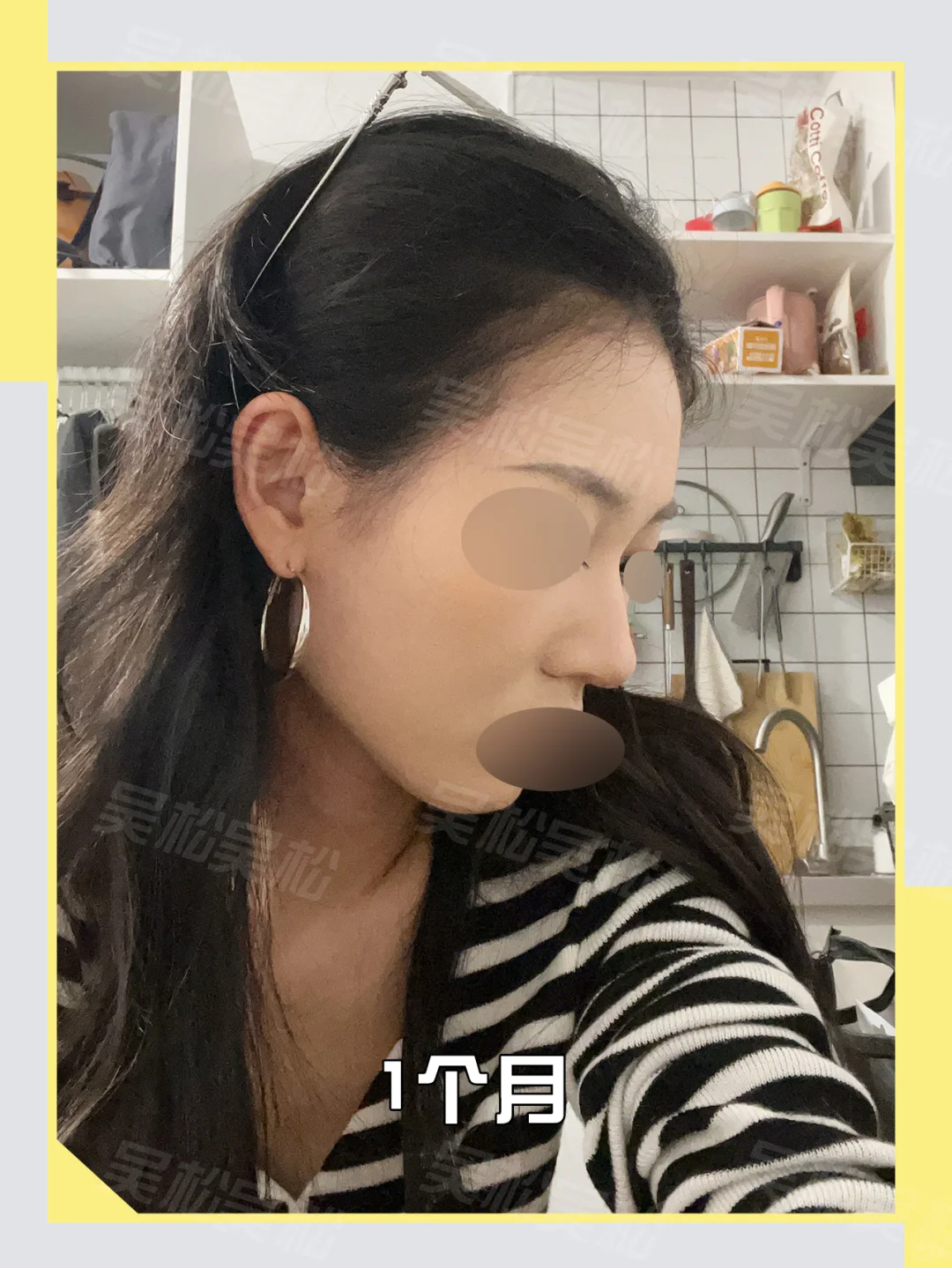 do鼻调整：塌鼻爆改自然精致鼻！