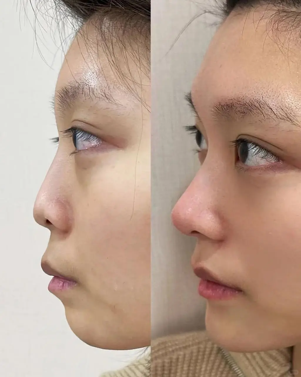 下巴后缩➕鼻子，3支就够了