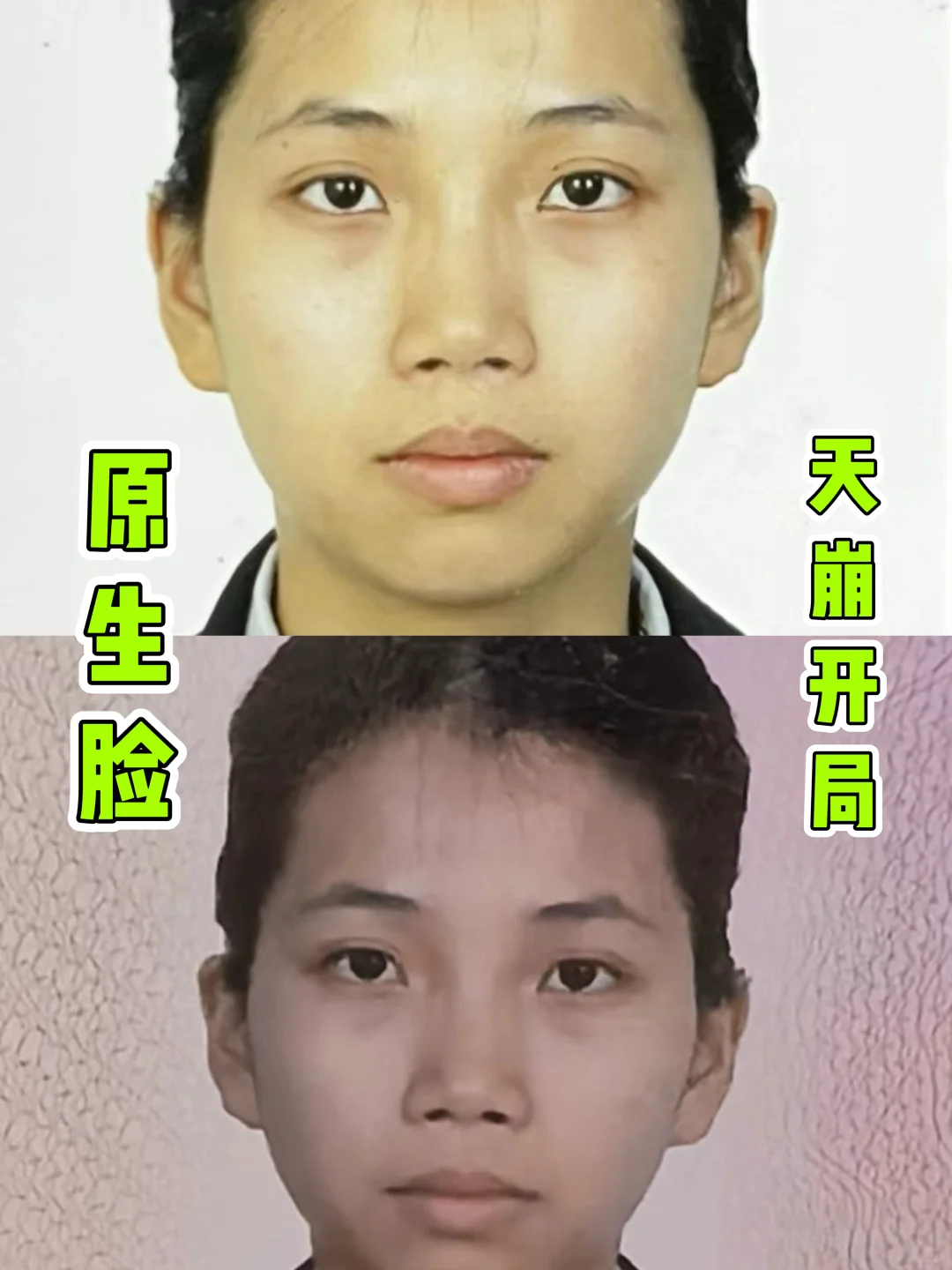 鼻子3次变化过程自卑只要70万就能消失