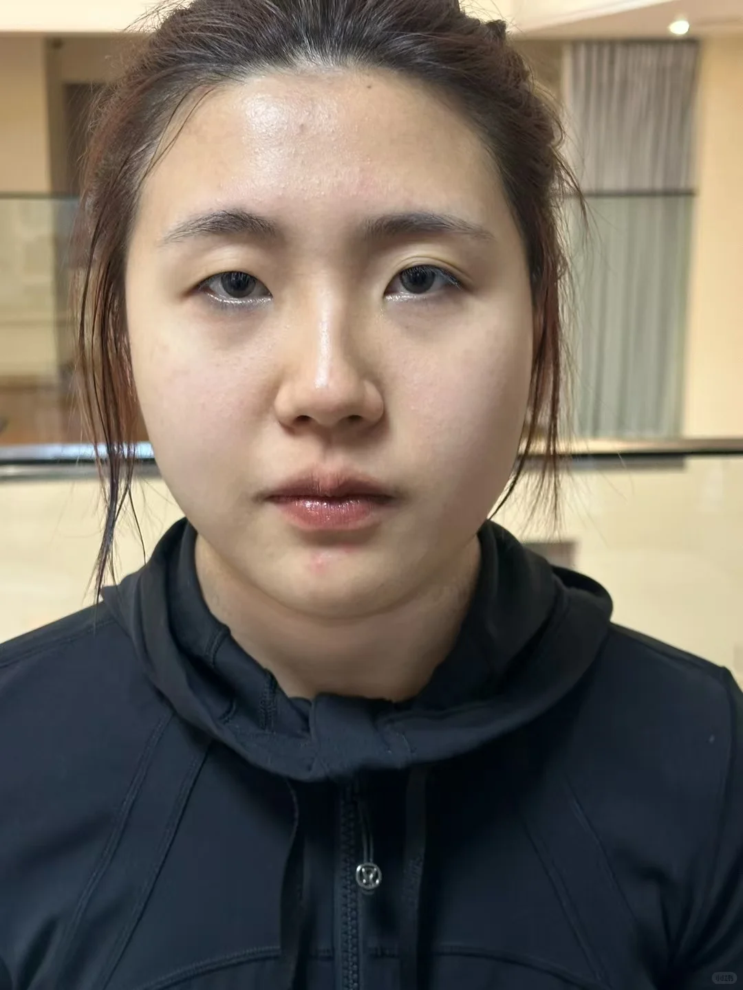 无痕媚眼术前后对比