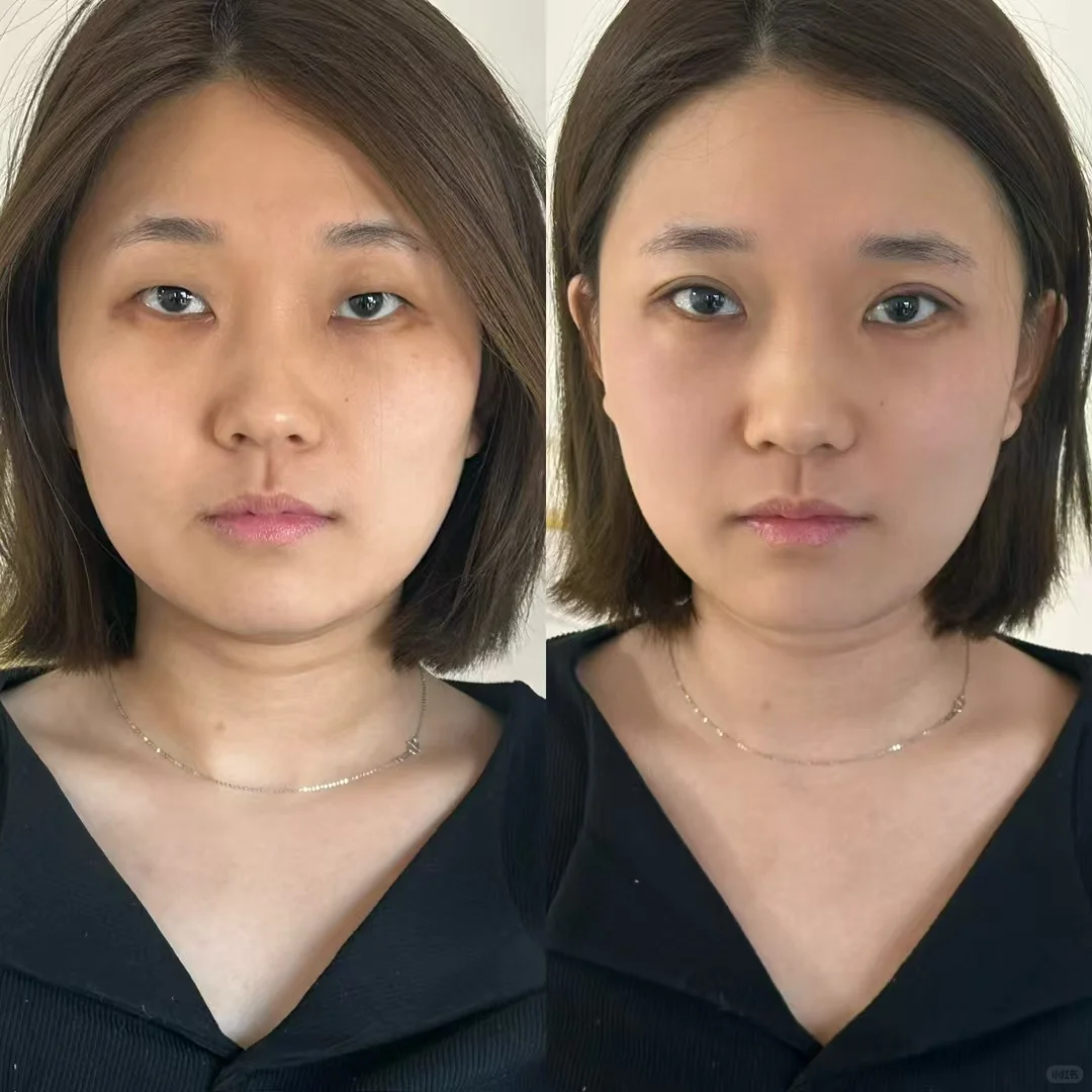 无痕媚眼术前后对比