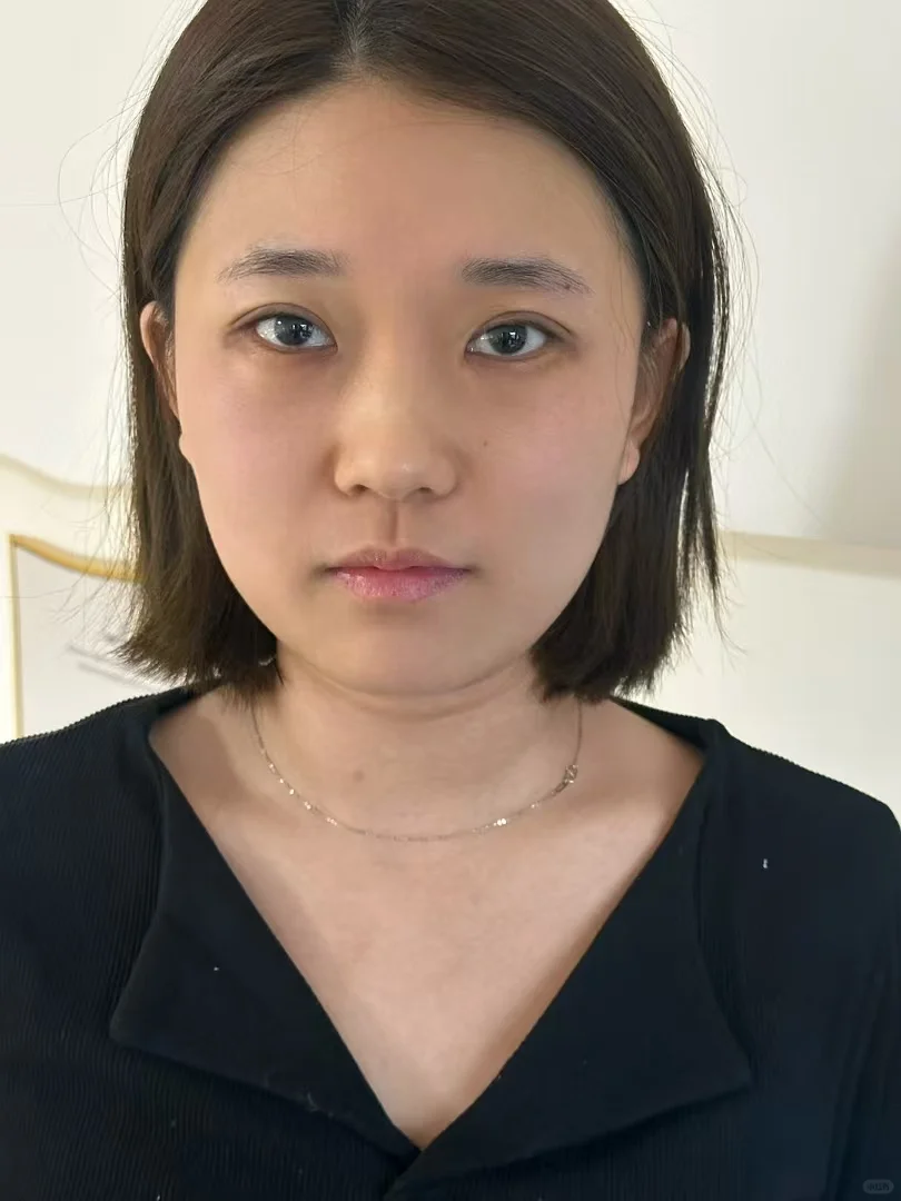 无痕媚眼术前后对比