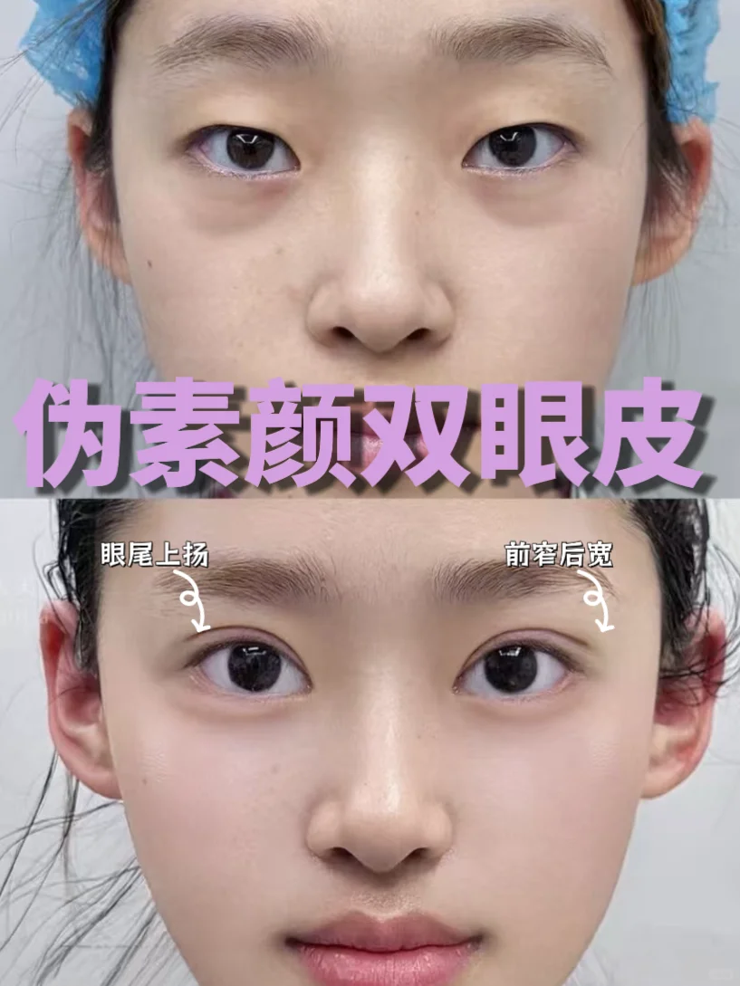 连云港do眼 | 伪素颜双眼皮，美到犯规！