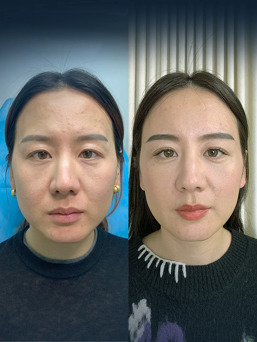 黄金媚眼针|眼部颜值回春首选