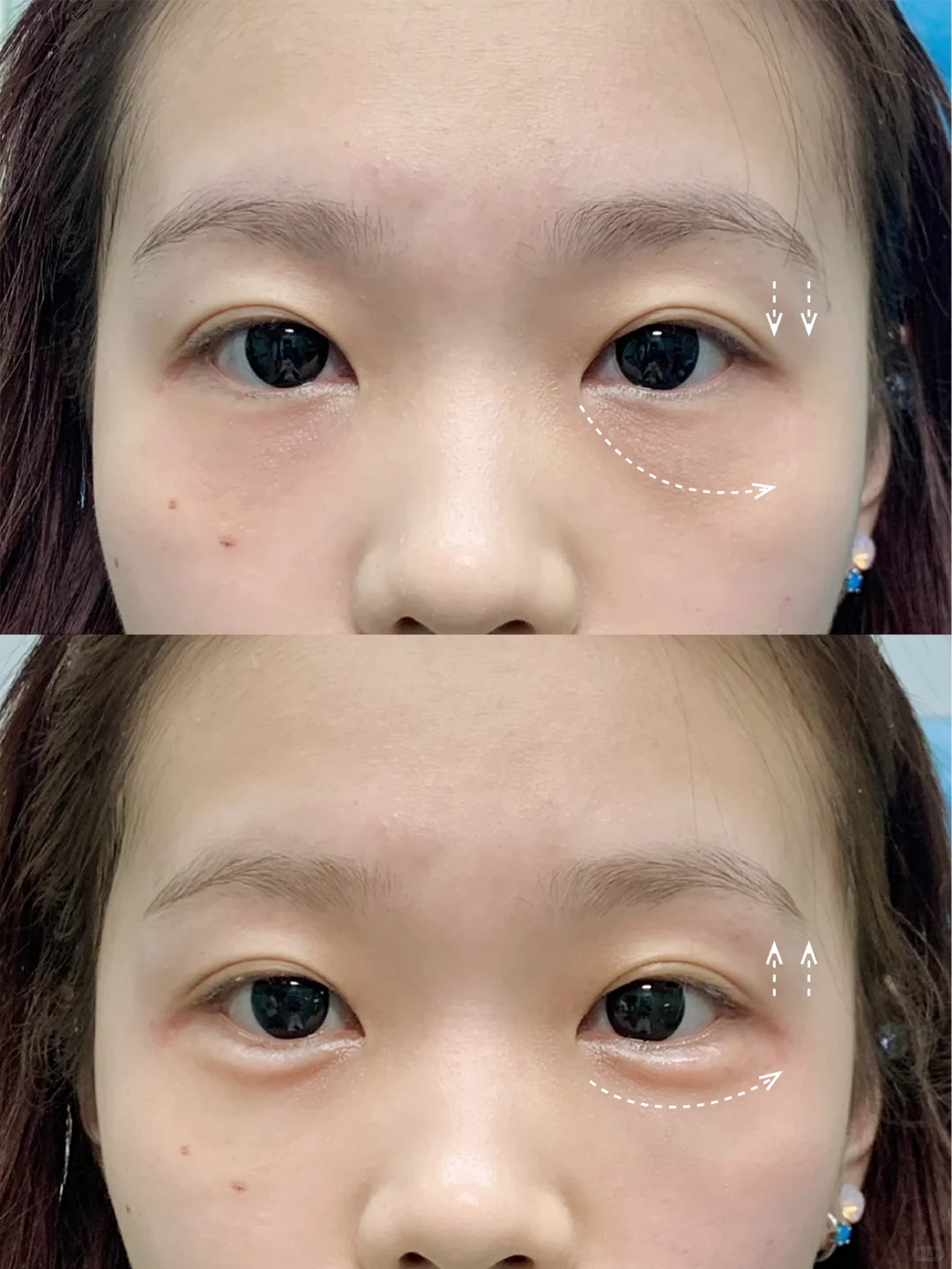媚眼针 告别眼部疲态