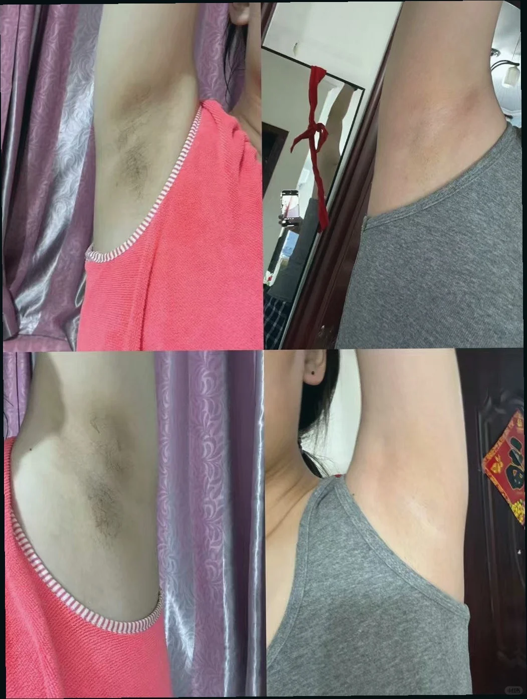 重要场合别被腋下黑毁了！婚纱比基尼都能穿