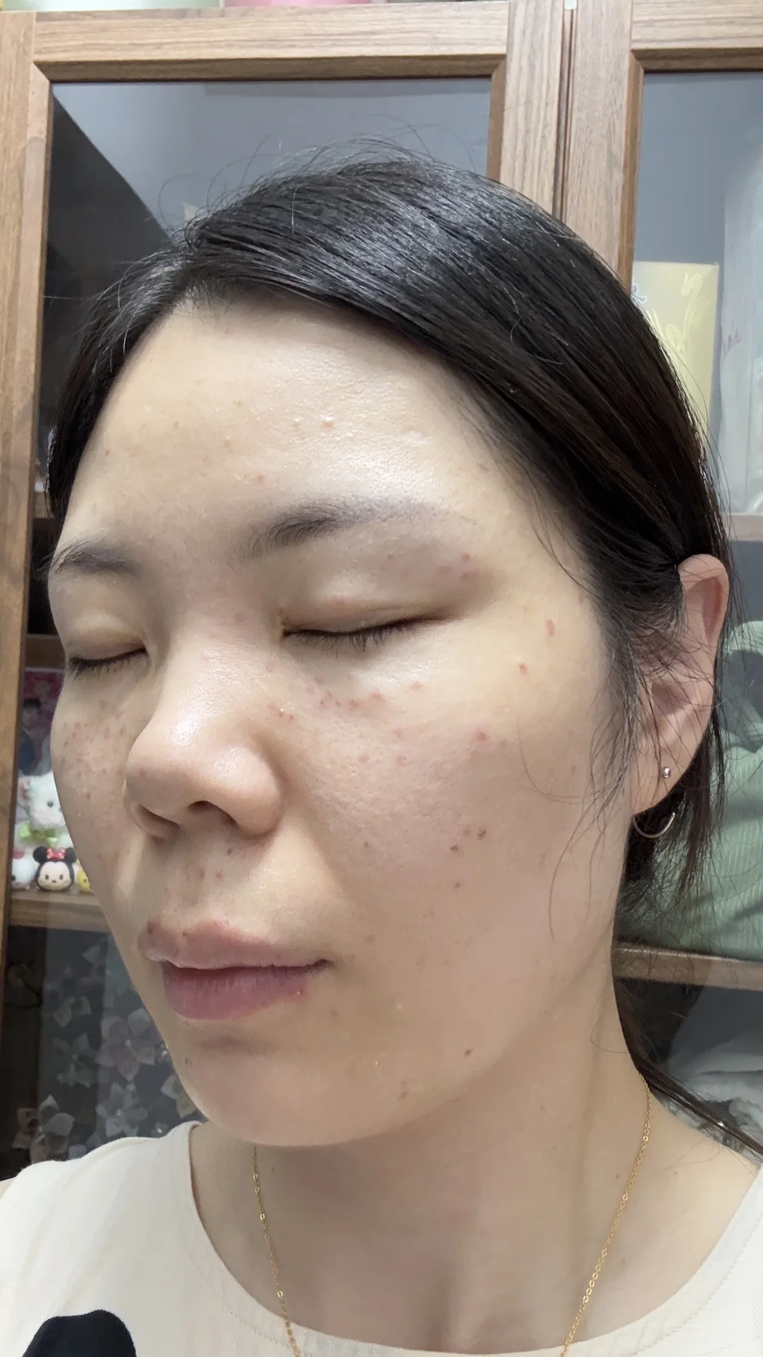 南京皮研所祛斑第一天