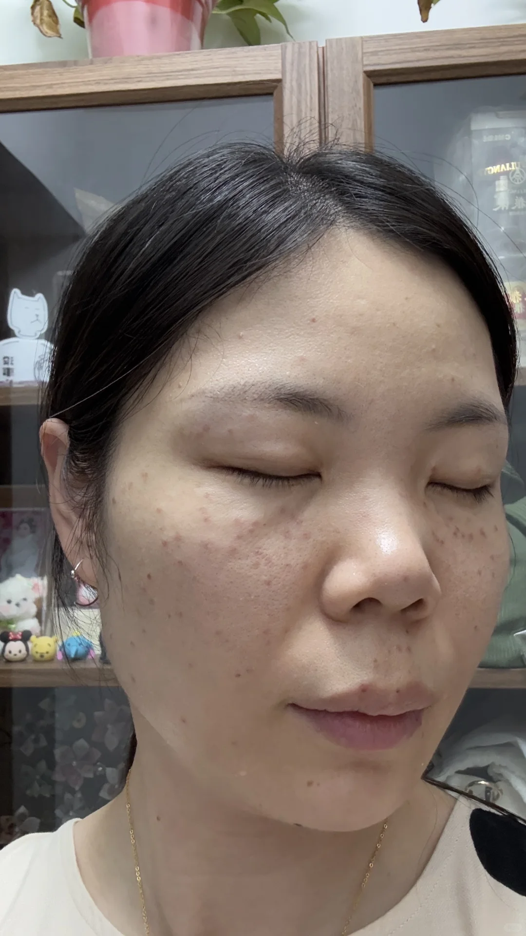 南京皮研所祛斑第一天