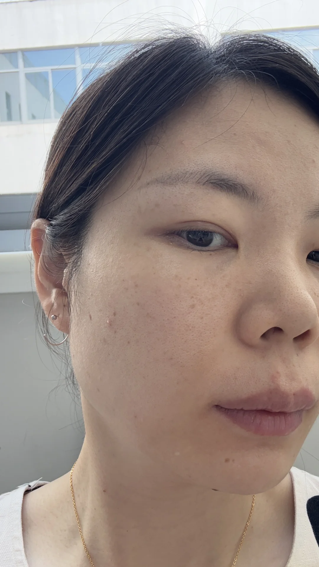 南京皮研所祛斑第一天